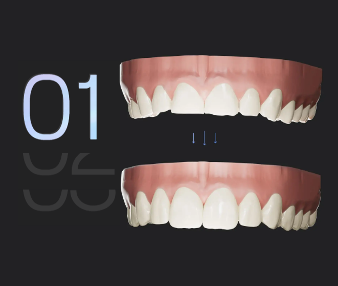 Nous commençons par réaliser des photos et un scan de vos dents. Une fois les données intégrées dans le logiciel FirstFit, nous effectuons toutes les modifications nécessaires — tout se fait virtuellement.