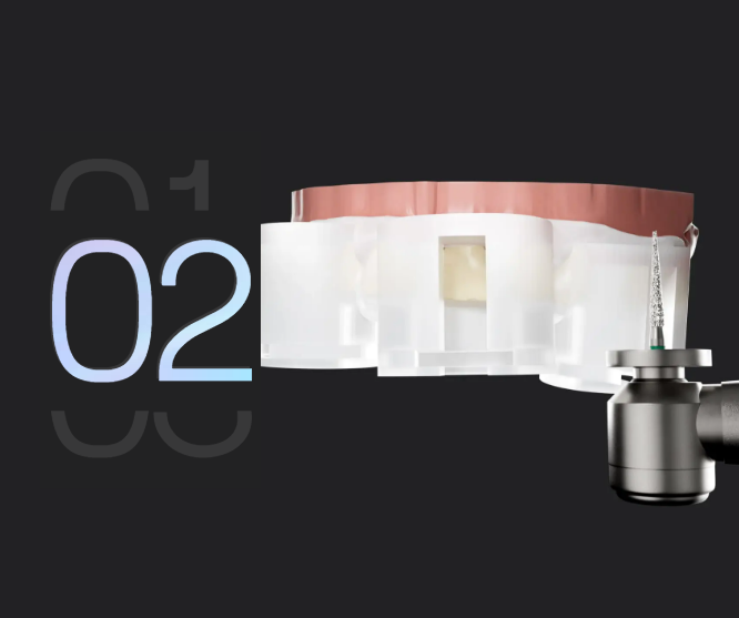 Ici, on passe au concret ! Nous préparons vos dents en plaçant le guide qui oriente la turbine et permet de tailler uniquement ce qu’il faut, tout en préservant au maximum l’émail dentaire.