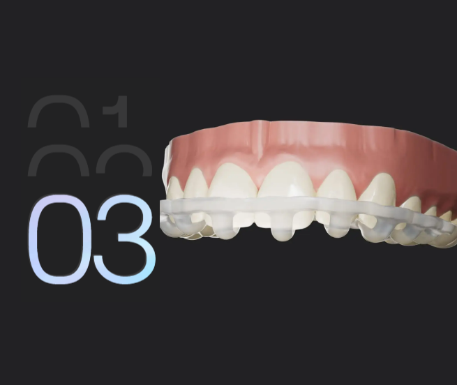 Ici, nous posons le guide One Step sur vos dents, ce qui permet d’installer jusqu’à 10 facettes en une seule étape.